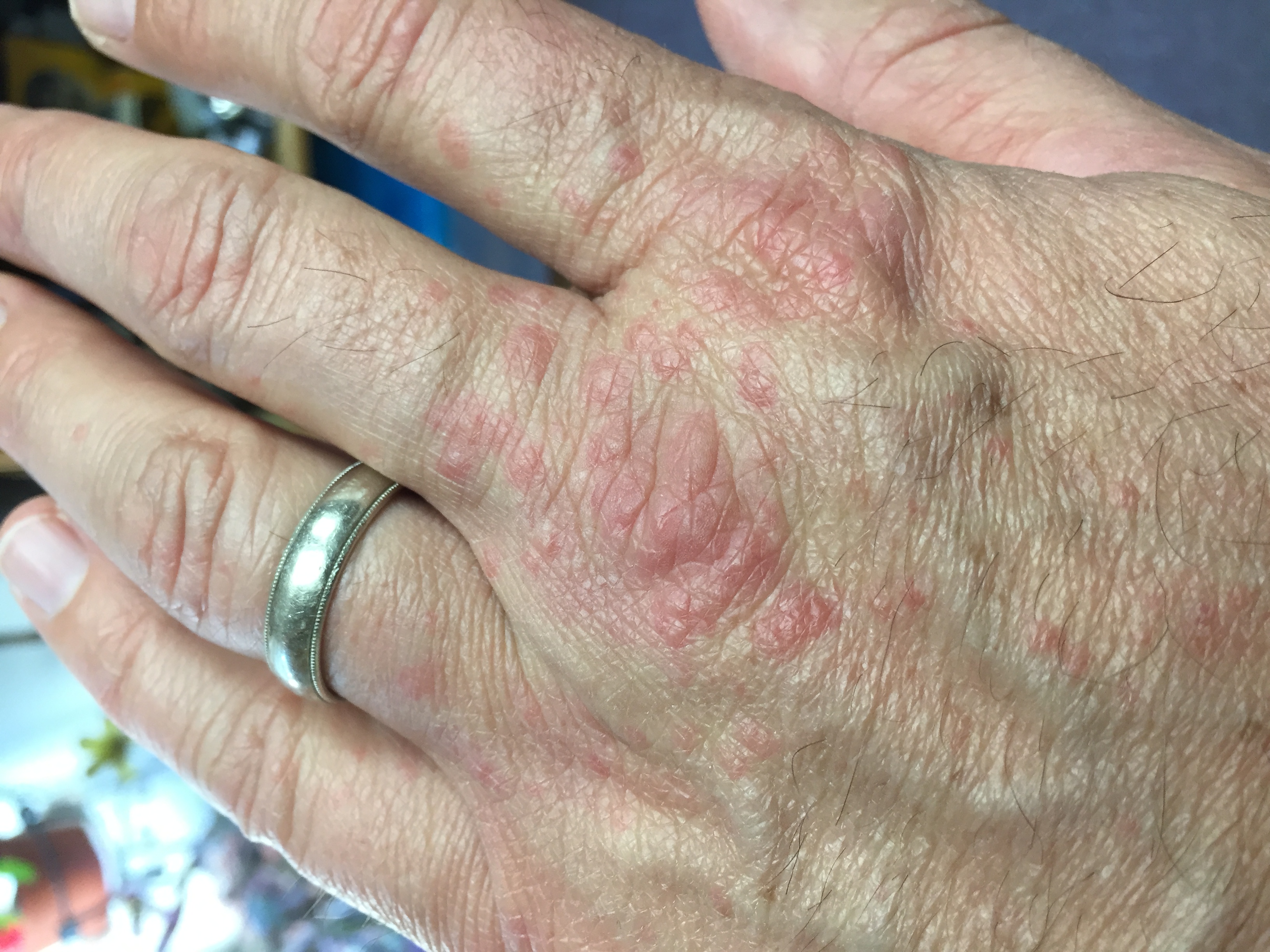 English Ivy Rash 